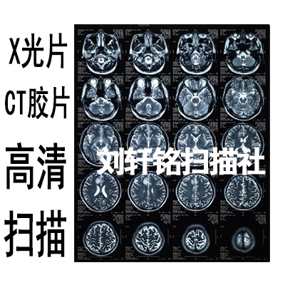 X光片扫描 CT核磁共振胶片扫描