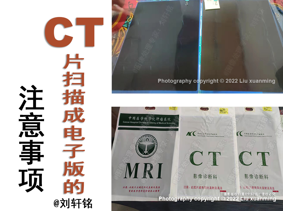 CT片扫描成电子版应该注意哪些问题